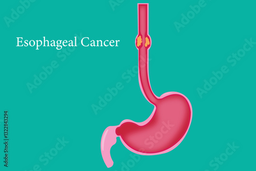 Anatomical illustration of esophageal cancer in the human digestive system.