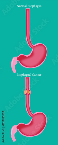 Esophageal cancer comparison with healthy esophagus diagram