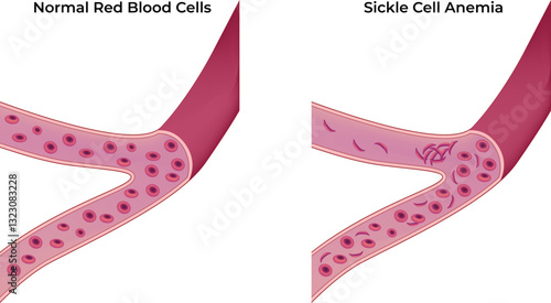 Comparison of Normal Red Blood Cells and Sickle Cell Anemia Vector Illustration