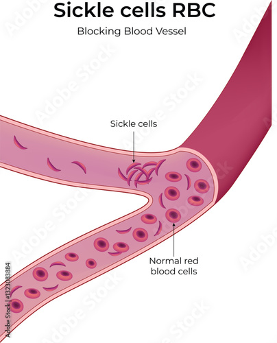 Illustration of sickle cells blocking a blood vessel Vector Illustration