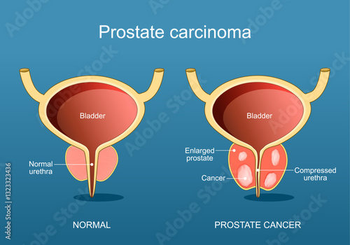 Prostate cancer. Adenocarcinoma