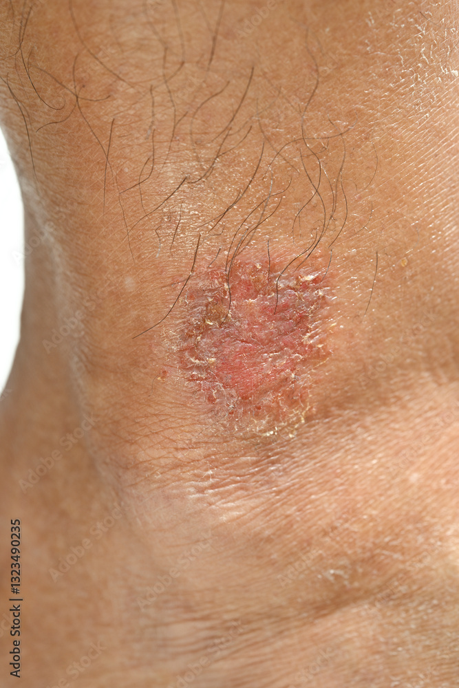 Fototapeta premium Skin disease winter