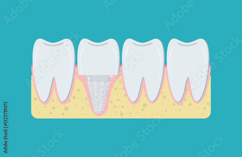 Vector illustration Dental restoration. Dental implant. Dental prosthesis.