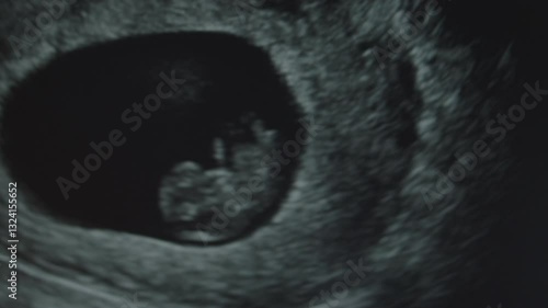 Ultra Sound of a Baby at 9 Weeks