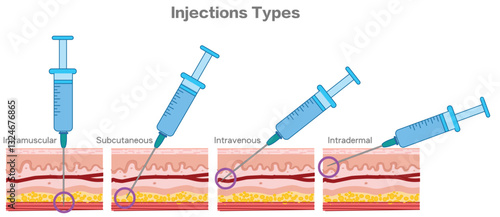 Injection angle types. Intramuscular, subcutaneous intradermal, intravenous injection. Guide injecting medication into skin, holding syringes. Vector illustration
