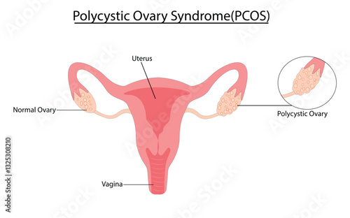 Polycystic Ovary Syndrome (PCOS) vector illustration