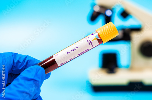 Immune marker Assesses globulin levels, elevated in cancers