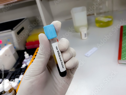 Scientist hold blood sample for von Willebrand factor test. Healthcare and medical test concept.