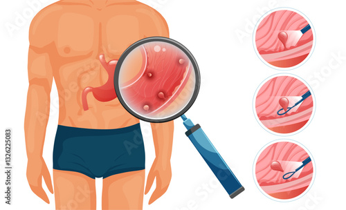 Stomach polyp detection and removal. Close up images depicting the endoscopic removal procedure. Vector medical illustration.