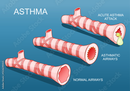 Normal bronchi and bronchioles during asthma attack photo