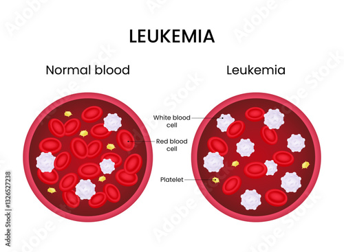 Comparison of normal blood and leukemia affected blood