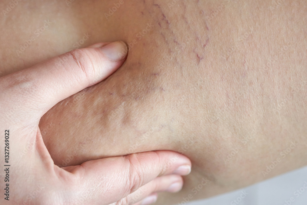 Close up of cellulite and stretch marks on caucasian female skin with hand touching affected area. Close up of cellulite and stretch marks on caucasian female skin with hand touching affected area.