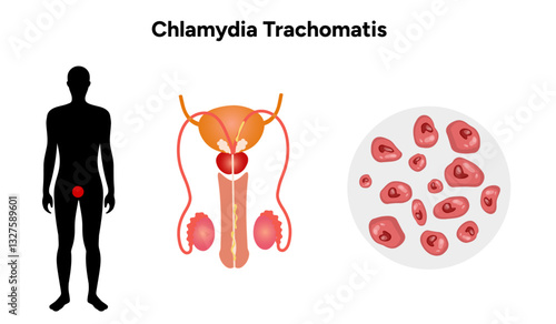 Chlamydia Trachomatis. Woman’s and man's reproductive system infections. Medical disease 