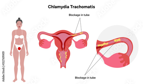 Chlamydia Trachomatis. Woman’s and man's reproductive system infections. Medical disease 