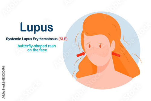 Flat illustration of Lupus disease. Butterfly rash on woman face. Medical illustration concept.