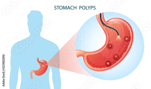 Stomach polyps under magnification. Concept of diagnosis, treatment and prevention of gastric cancer. Vector medical illustration.