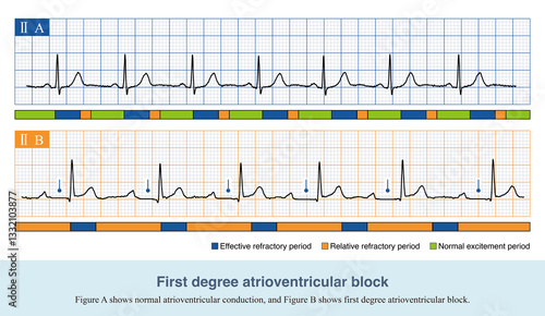 In the first degree of atrioventricular block, the PR interval was prolonged by more than ＞200ms, and there was no QRS wave loss in ECG. The blocking site can occur anywhere in the conduction system.
