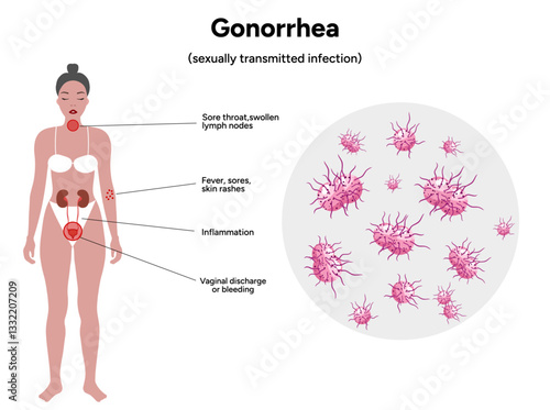 Gonorrhea. Human reproductive system transmitted infection virus bacterial. Medical diagram symptoms 