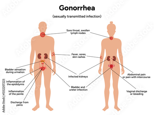 Gonorrhea. Human reproductive system transmitted infection virus bacterial. Medical diagram symptoms 