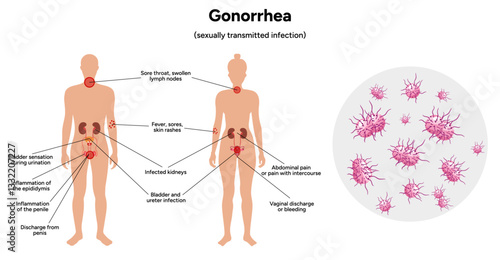 Gonorrhea. Human reproductive system transmitted infection virus bacterial. Medical diagram symptoms 