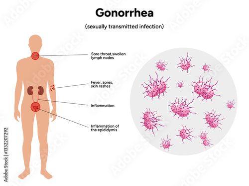 Gonorrhea. Human reproductive system transmitted infection virus bacterial. Medical diagram symptoms 