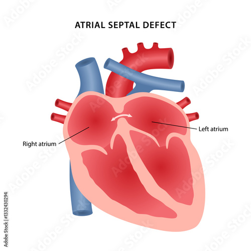 Atrial septal defect, heart defect. Medical illustration of a diseased human heart with the atria labeled. Vector illustration in a flat style.