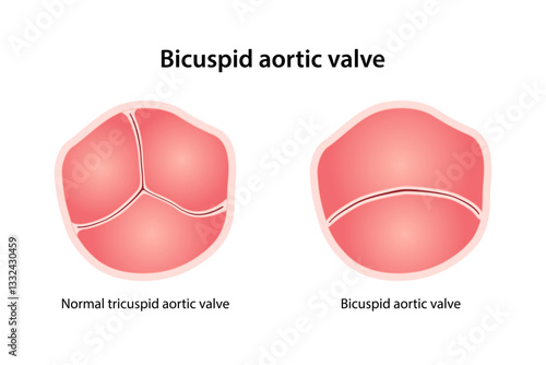 Bicuspid aortic valve, congenital heart defect. Medical illustration of healthy and defective valve. Vector illustration in flat style