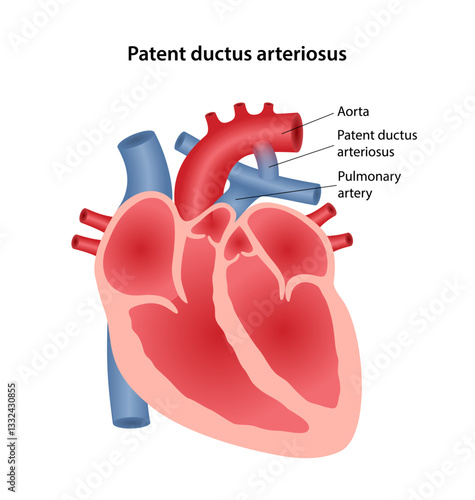 Patent ductus arteriosus, congenital heart defect. Medical illustration of heart defect. Vector illustration in flat style.
