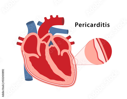 Pericarditis, inflammation of the lining of the heart. Medical illustration of heart with an enlargement of the pathological area of lining of heart. Vector illustration in flat style