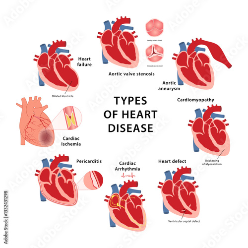 Heart disease types. Medical vector illustration of aortic valve stenosis, aortic aneurysm, cardiomyopathy, thickening of myocardium, heart defect, arrhythmia and ischemia, pericarditis, heart failure