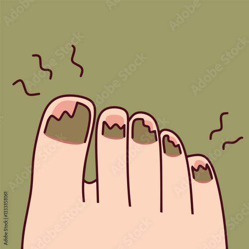 Toenails with a fungal infection, showing discoloration and damage. A medical issue requiring treatment and care.