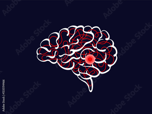 Ischemic stroke. Human brain, red cerebral artery