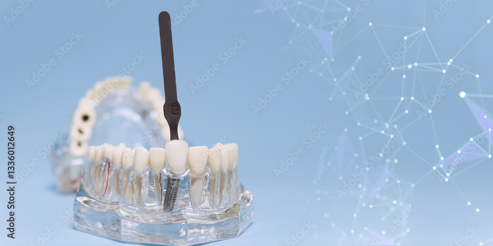 dental shade guide comparing tooth color on an implant model, with a futuristic digital background representing dental technology advancements