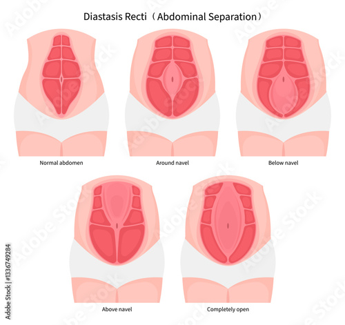 Type of abdominal muscle separation after surgical which in medical called Diastasis Recti belly