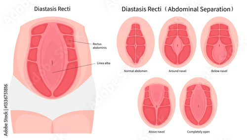 Separation of Abdominal muscle which in medical called Diastasis Recti belly