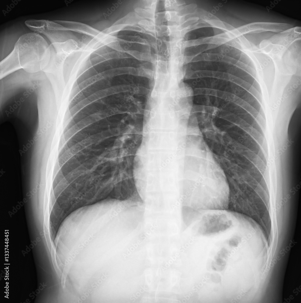 Human chest X-ray showing lungs and ribcage in grayscale. Lungs, ribs and heart radiography medical image. Health, diagnostics and anatomy concept Human chest X-ray showing lungs and ribcage in grayscale. Lungs, ribs and heart radiography medical image. Health, diagnostics and anatomy concept