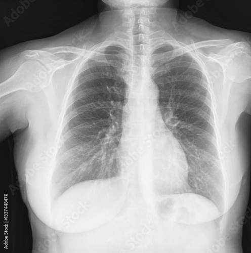 Human chest X-ray showing lungs and ribcage in grayscale. Lungs, ribs and heart radiography medical image. Health, diagnostics and anatomy concept