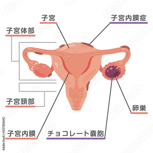子宮内膜症になった子宮のイラスト1