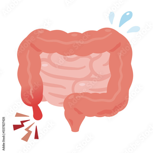 虫垂炎になった腸のイラスト