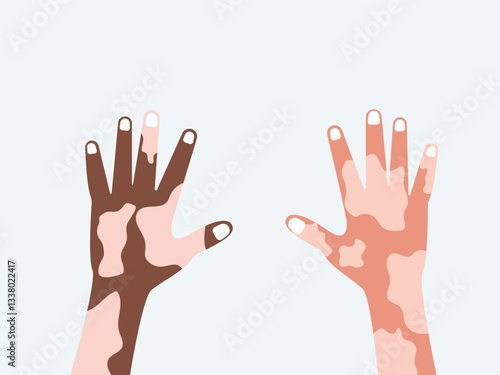 Sowing on the Human Hand Vitiligo world vitiligo day. Skin disease. Self care and self love. Vector illustration