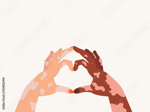 Love sign made with two vitiligo skin hands World vitiligo day awareness. Concept of love, support, diversity. vitiligo illustration