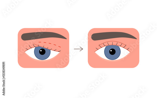 Eyelid correction, blepharoplasty. Before and after aesthetic plastic surgery of eye. Lift eyelid. Surgical facial rejuvenation. Vector illustration