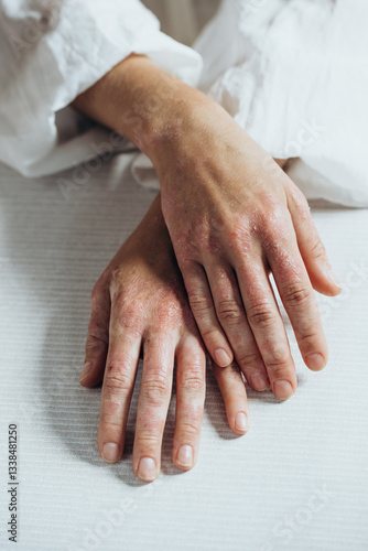 Sick person. Unrecognizable young woman suffering from autoimmune incurable dermatological skin disease called psoriasis. Large red inflamed scaly rash on elbows. joints affected by psoriatic arthriti