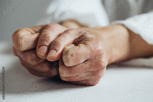 Sick person. Unrecognizable young woman suffering from autoimmune incurable dermatological skin disease called psoriasis. Large red inflamed scaly rash on elbows. joints affected by psoriatic arthriti