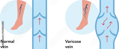 Varicose disease for healthcare infographic collection. Vector flat chart illustration. Vascular disease diagnostic and treatment. Healthy and varicose vein blood flow. Design for education