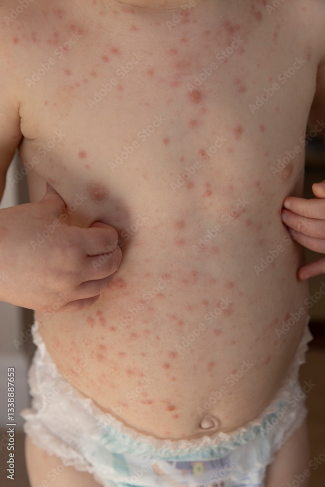 Fototapeta premium A young child with severe chicken pox illness covered in spots and blisters