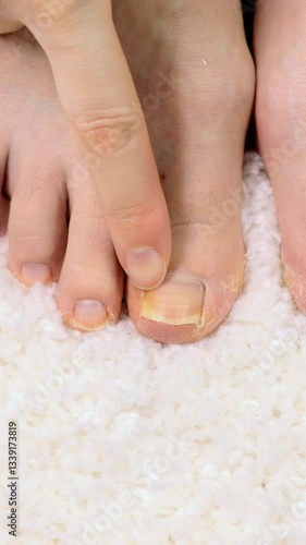 Vertical footage of a onycholysis on the toe. Detachment of the nail from the nail bed. Podiatry problems with thick toenails. Close up human finger on foot.