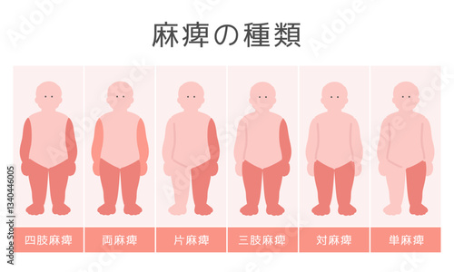 麻痺の種類　イラスト

