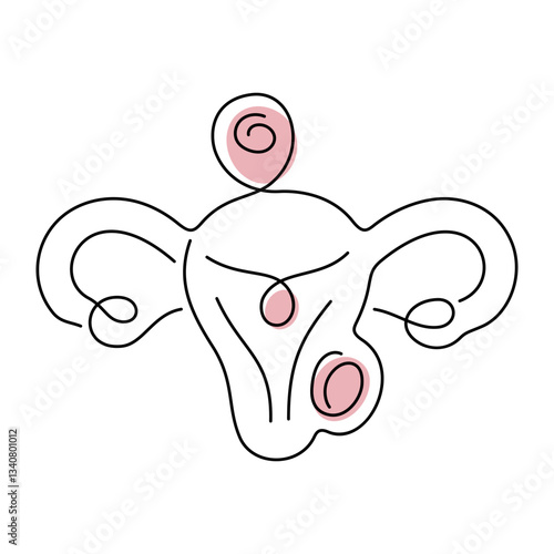 Uterine Fibroids medical illustration