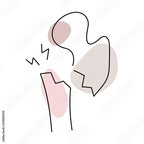 Osteoporosis broken bone medical illustration